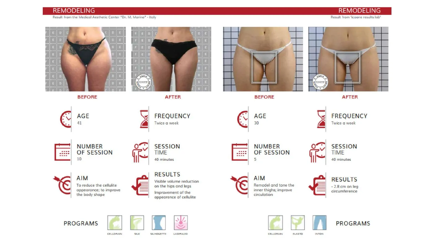 icoone® before and after — appearance of cellulite with session data