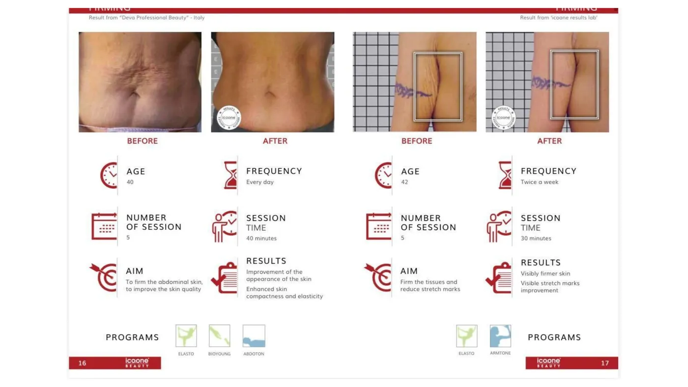 icoone® before and after — body firming
