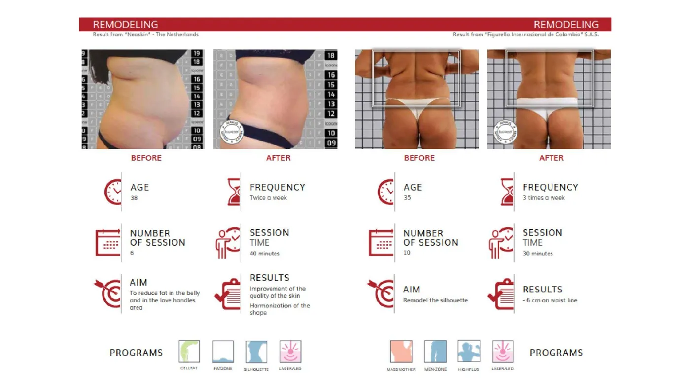 icoone® before and after — body remodelling
