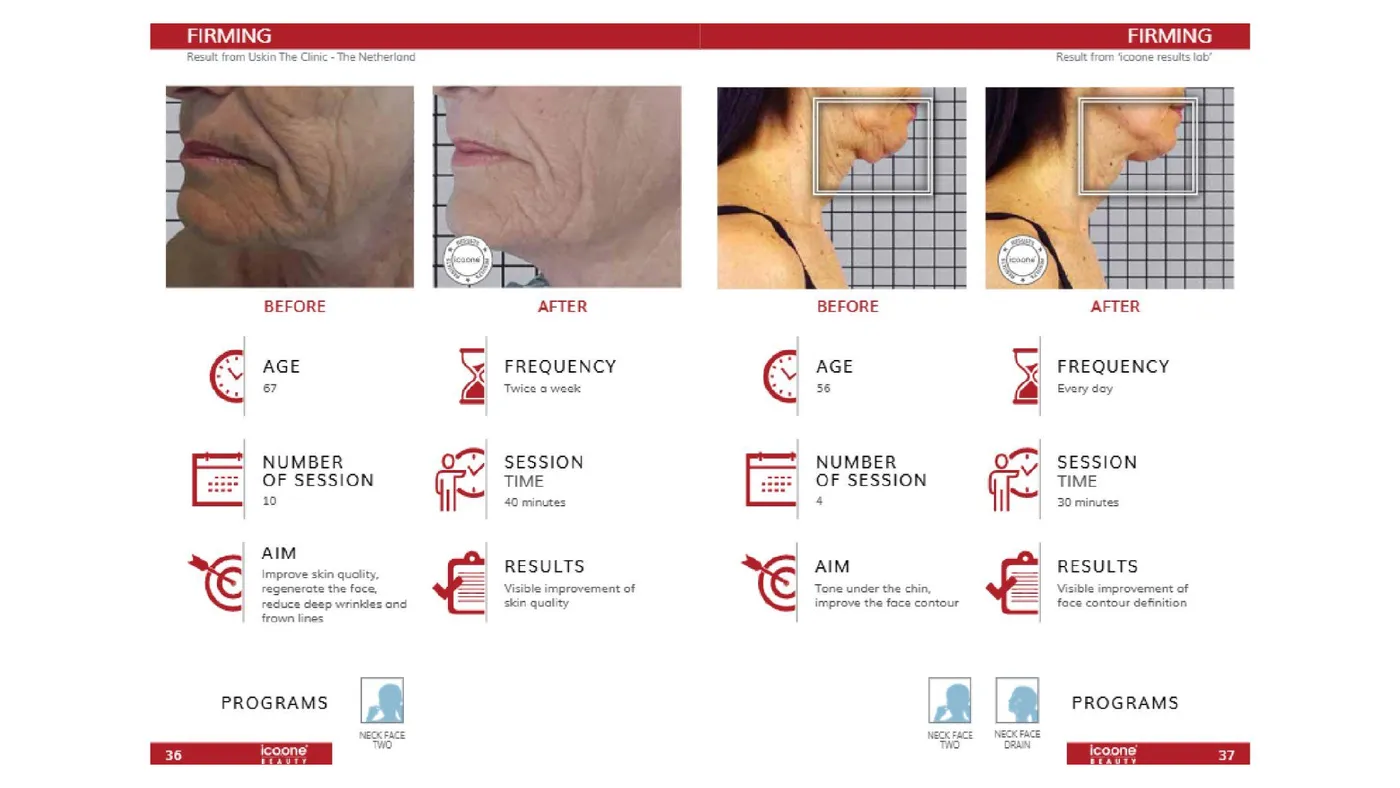 icoone® before and after — face and neck firming