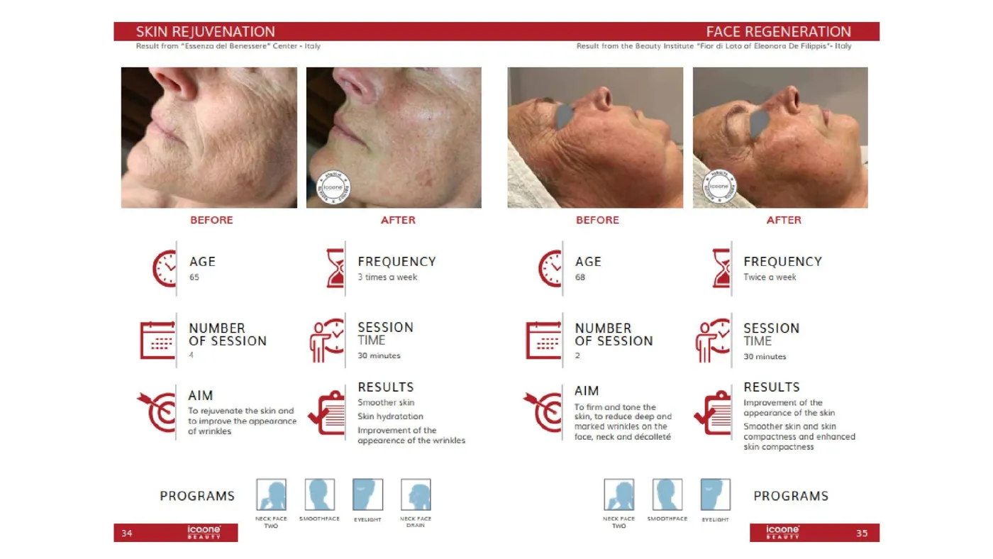 icoone® before and after — skin rejuvenation and face regeneration